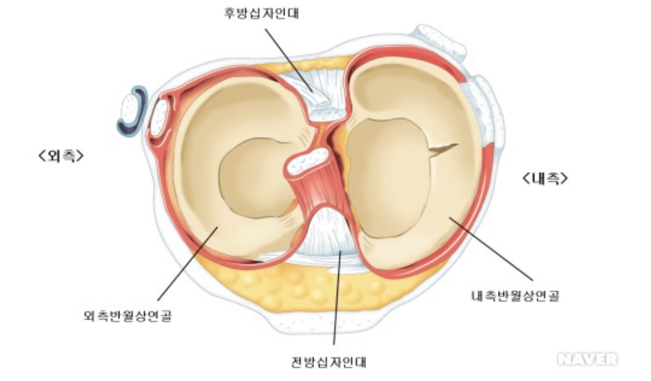 반월상연골파열