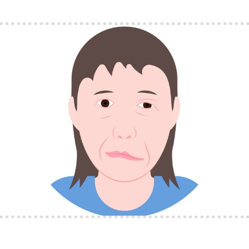 구안와사 원인 초기증상, 증상