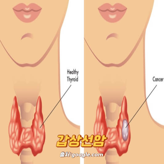 갑상선암