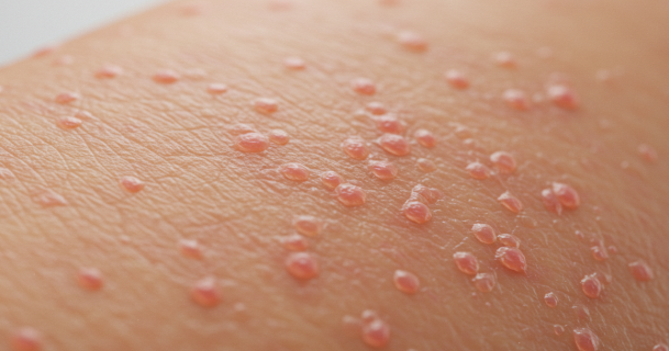 hives skin condition