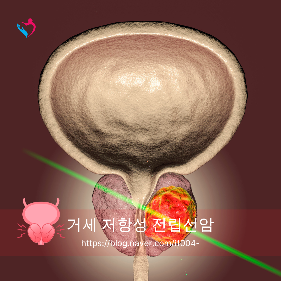 최신 의료 루테슘(Lu-177) PSMA 거세 저항성 전립선암 치료에 대해