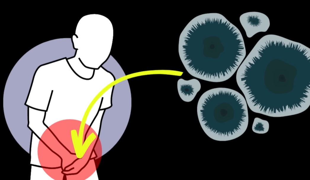 사타구니 가려움증