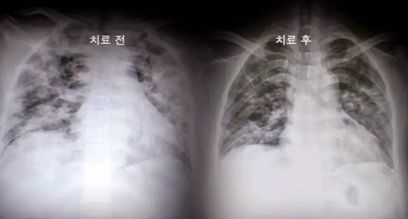 KBS 생로병사의 비밀 827회 재유행 코로나 연대기 2부 끝나지 않는 고통 코로나 후유증 롱코비드