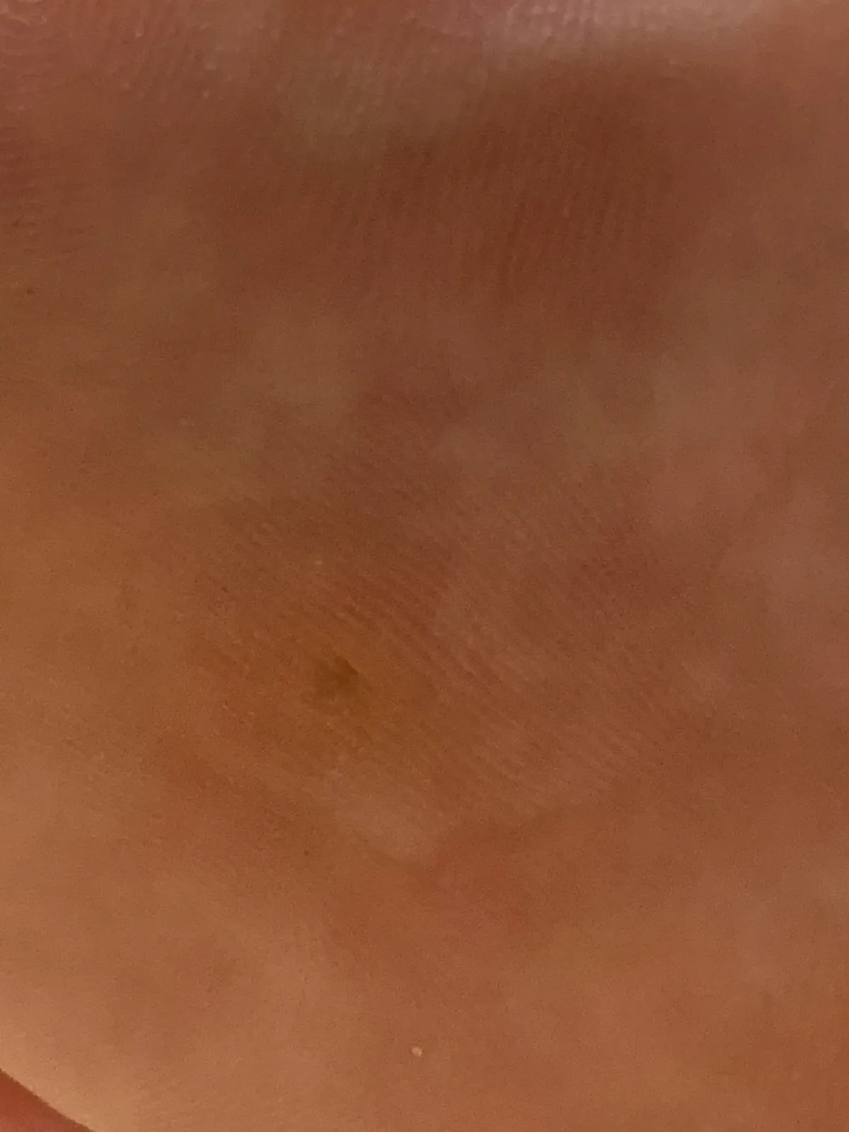 티눈밴드-사용전-발바닥