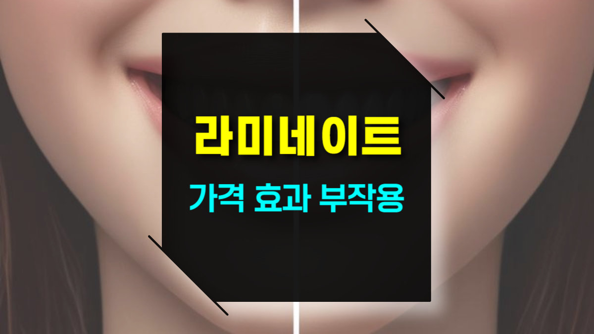 라미네이트란? 가격, 효과, 부작용 및 유지 관리법