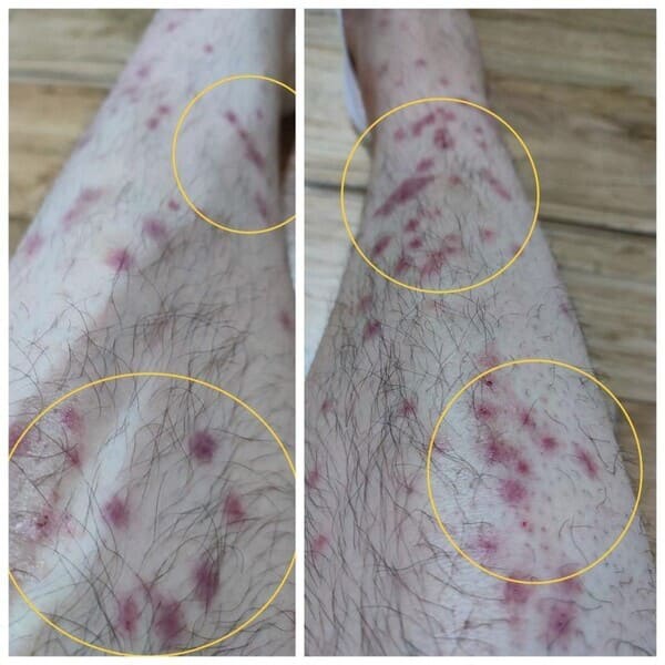 빈대에 물린 자국 사진