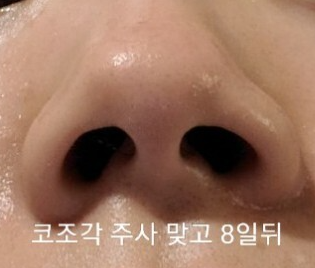 코조각주사 후기