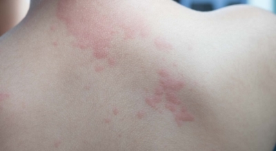 대상포진이미지