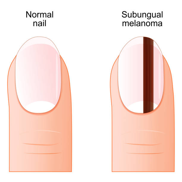 손톱 검은 세로줄