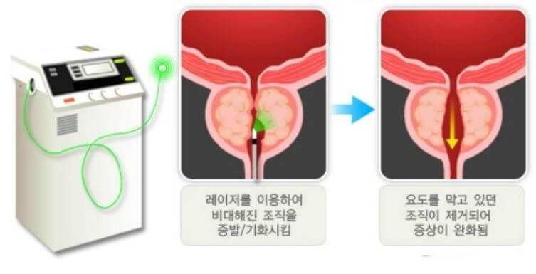 전립선비대증 증상 치료방법