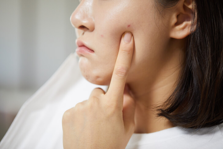 여드름으로 속상해 하는 여성