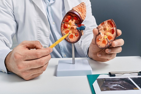 신장 결석의 원인과 증상 정리 (요산, 수산염, 칼슘)