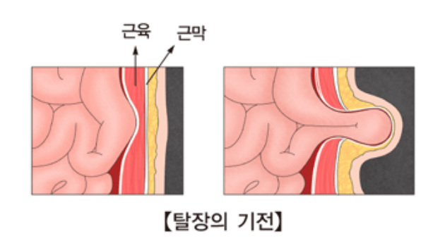 배꼽탈장