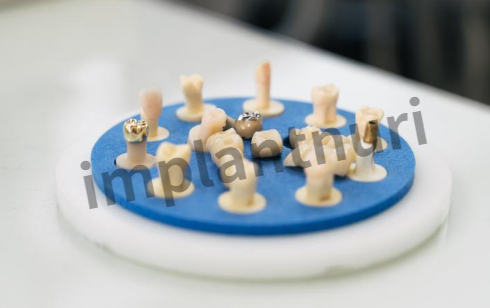 덴티스 임플란트 가격