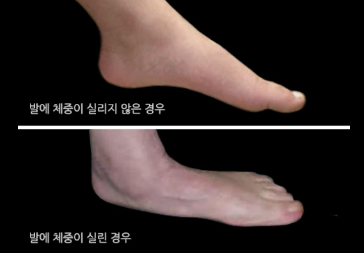 평발(2)