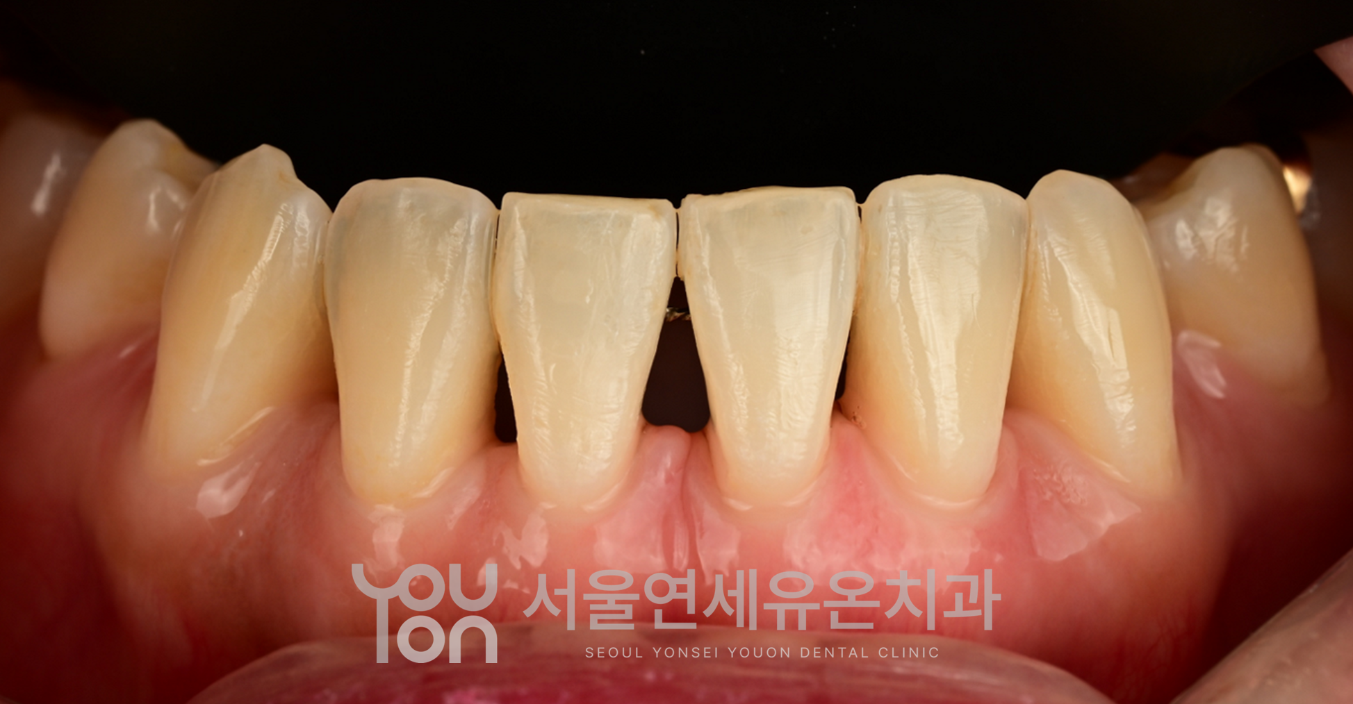앞니 사이 블랙트라이앵글 - 교정 후 치아 사이에 삼각형 공간이 보이는 모습