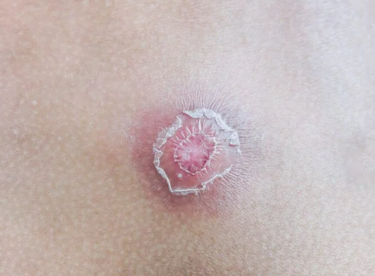 남자 사타구니 종기