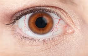 눈이 충혈되는 이유
