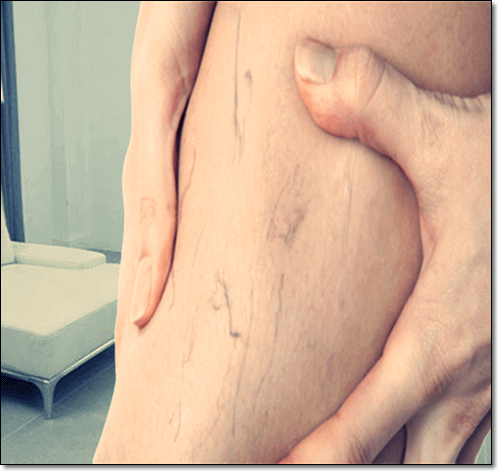 하지 정맥류 환자