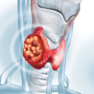 갑상선암 증상, 수술후 회복기간, 수술후 좋은음식 총정리 (2024ver)