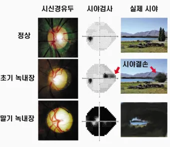 녹내장 진단 검사 비용 안압 검사주기 관리법_23