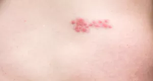 대상포진 증상