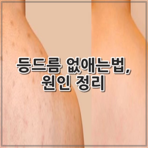 등드름 없애는법&#44; 원인 정리