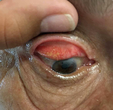 결막결석, 눈에 돌이 들어간것 같은 이물감, 결막결석 원인