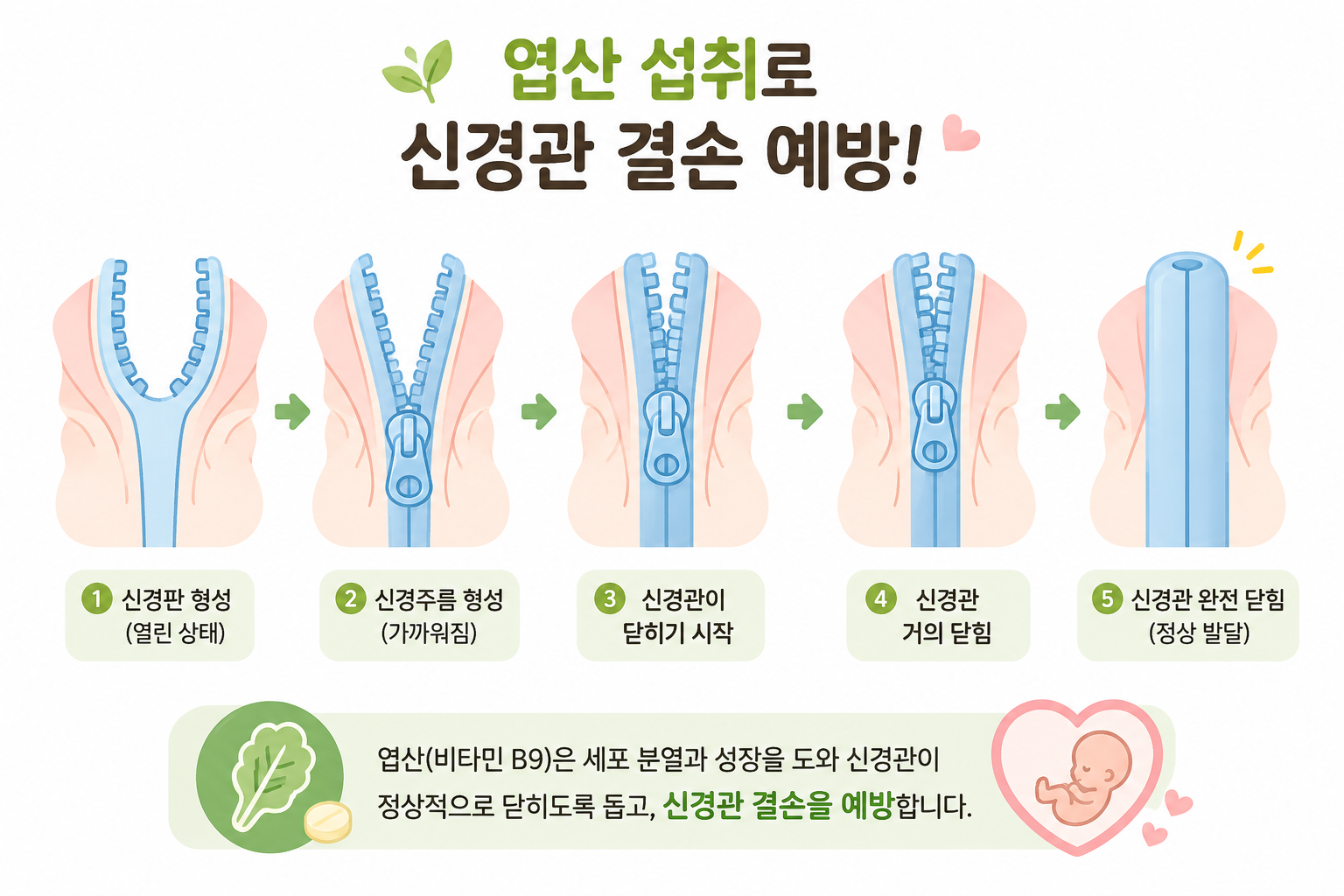 신경관이 닫히는 모습을 지퍼 닫는 모습에 비유 인포그래픽