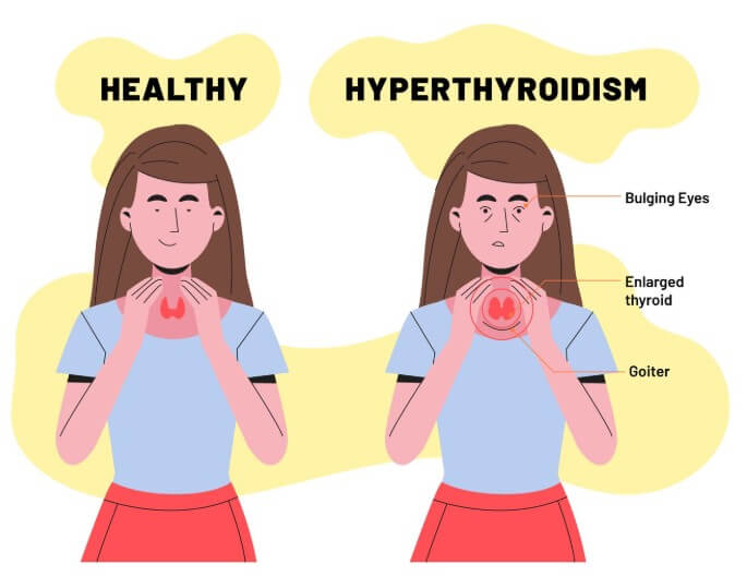 갑상선암 초기증상