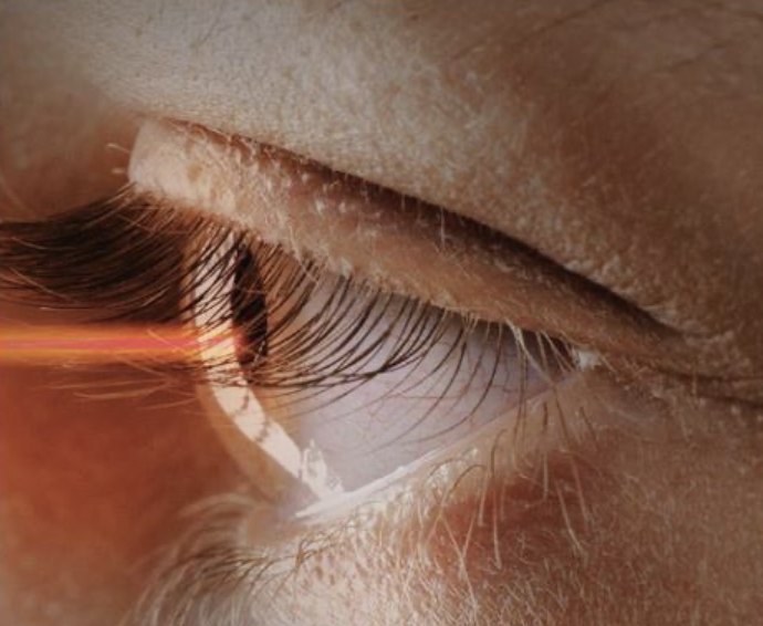 스마일라식-비용-부작용