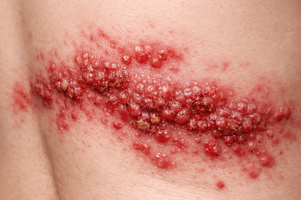 역류성 식도염 증상 이것만 알면 끝