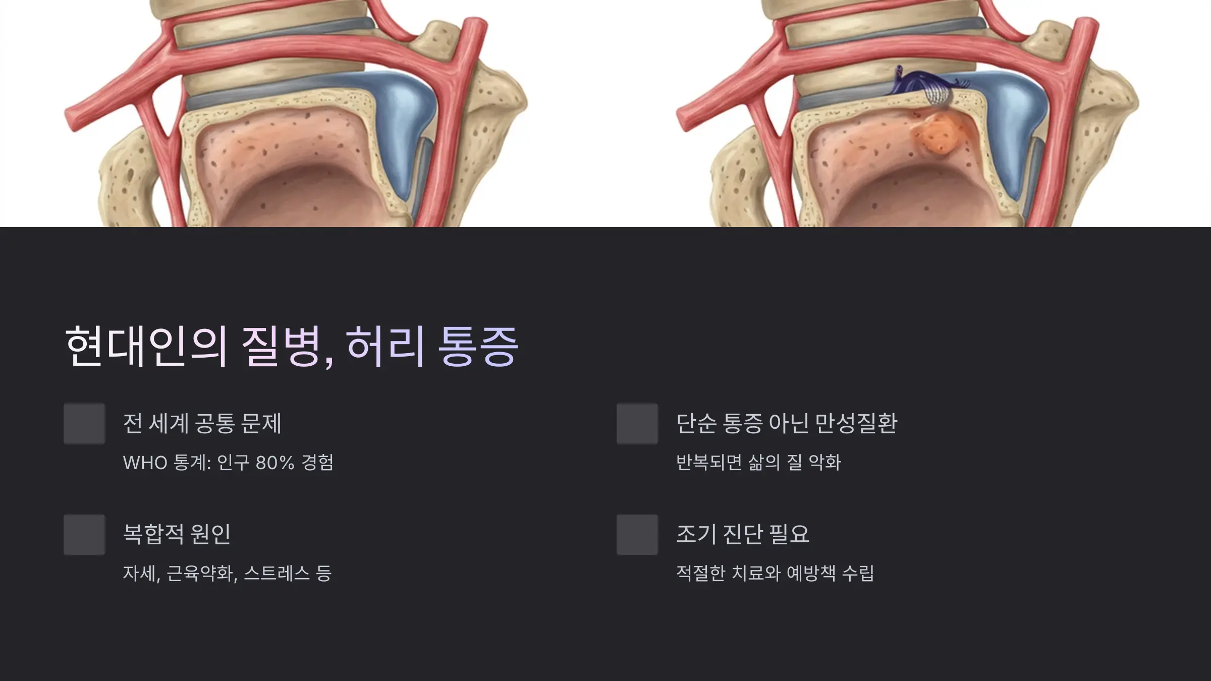 허리 통증, 단순한 근육통이 아닌 현대인의 질병