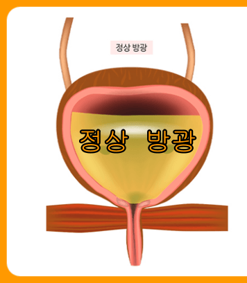 요실금 검사방법