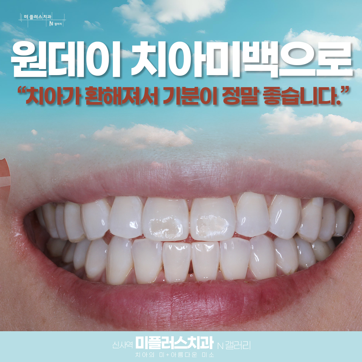 치아미백 시술 후 햐얗게 개선된 치아 상태