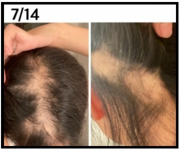 7월14일-탈모