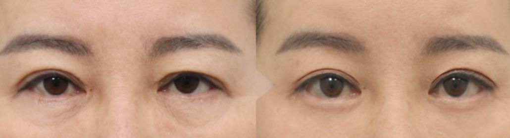 눈꺼풀 수술 비용, 처진 눈꺼풀 수술 종류는?