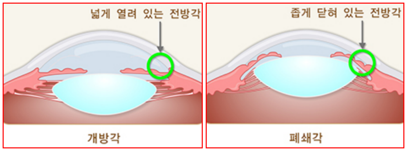 개방가과폐쇄각
