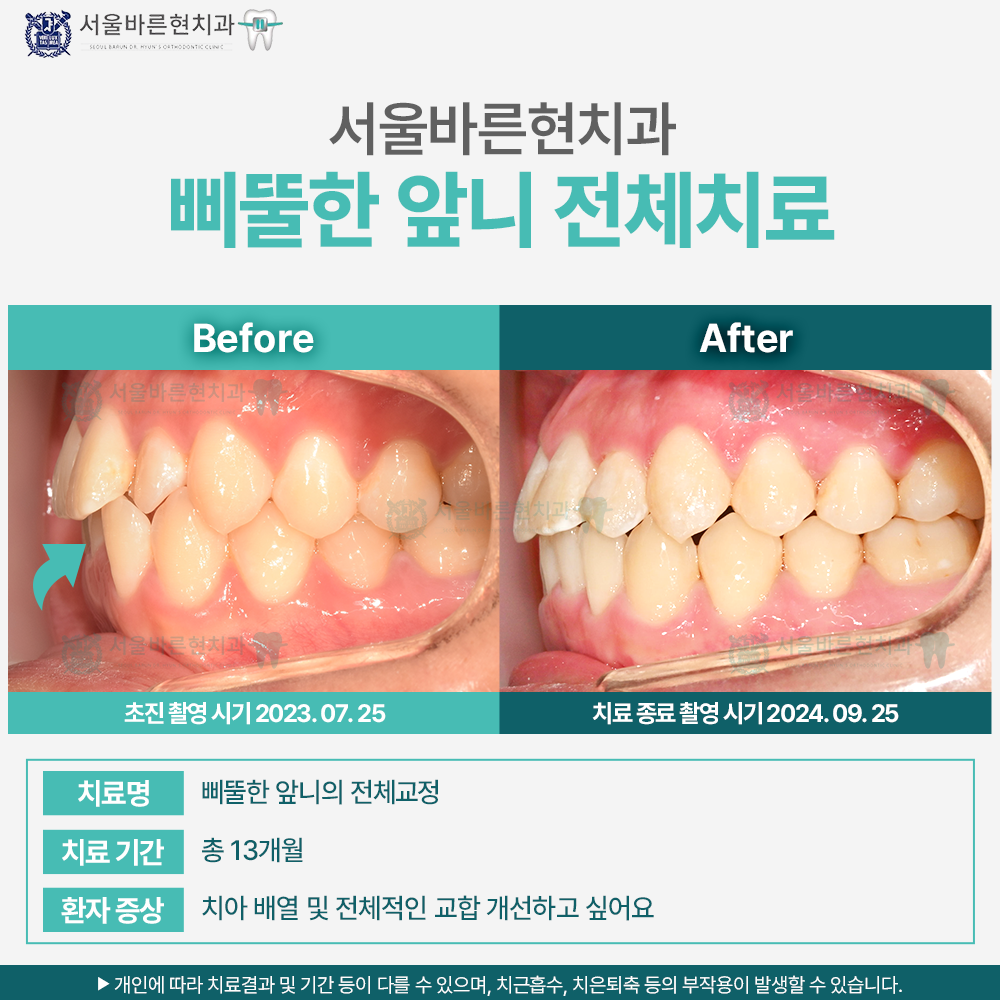 부산치아교정
