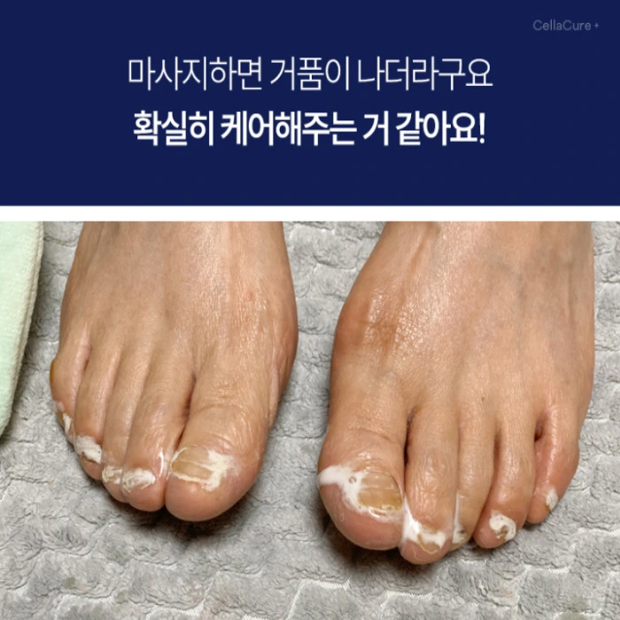 셀라큐어 문제성 발톱 솔루션 내돈내산 후기 부작용 성분 효능 사용법 가격 
