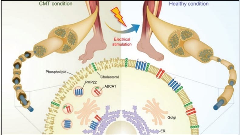 대구경북과학기술원, 세계 최초 샤르코-마리-투스(CMT) 치료법 개발 Scientists develop world's first Charcot-Marie-Tooth therapy