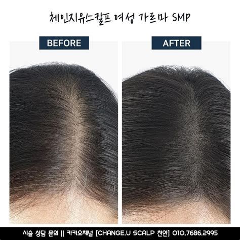천안 탈모