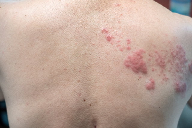 The image behind the shoulder of the shingles