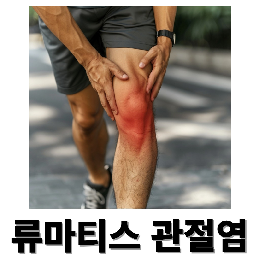 류마티스 관절염과 관련된 사진입니다.