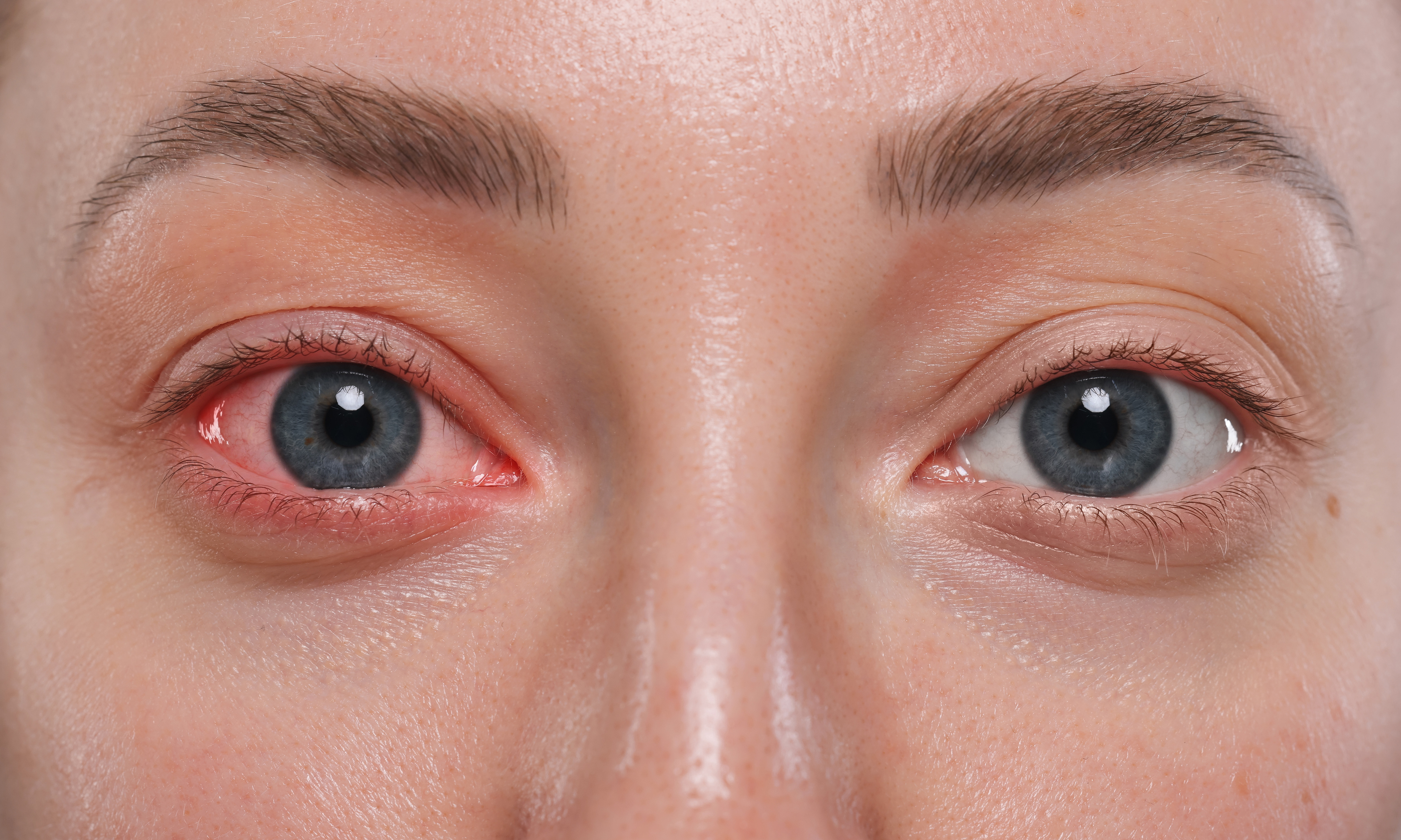 환절기_알레르기_결막염_원인_전염