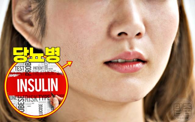 피부당김 얼굴당김 피부건조 가려움 원인 당뇨병
