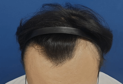 탈모의 원인과 해결방안