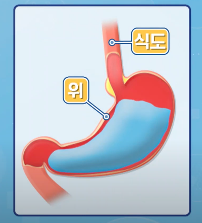 역류성 식도염 증상