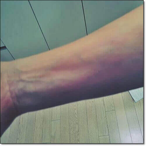 한랭 두드러기 증상