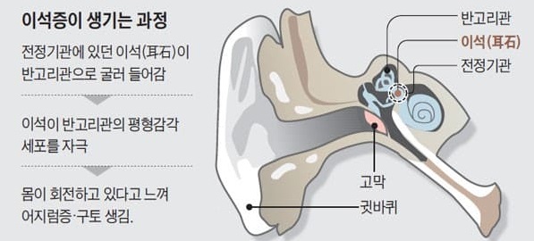 이석증이 생기는 과정